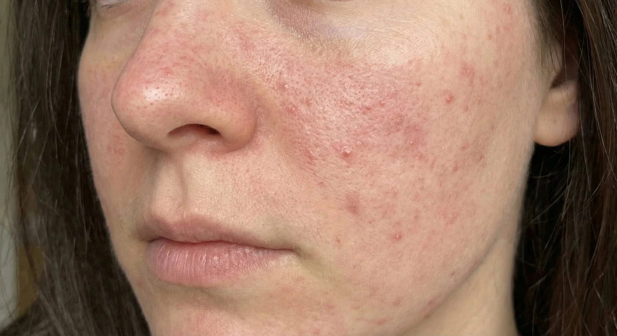 Færre udbrud og mere ro